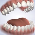 Post-Operative Care for a Successful Recovery After Dental Surgery