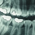 Safety Precautions for Dental X-Rays: What You Need to Know