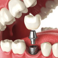 The Importance Of Choosing A Safe Dental Implant Provider In Canberra