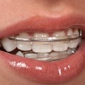 Why Dental Safety Matters: Choosing A Trustworthy Cosmetic Dentist In Bexley