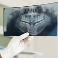 The Benefits of Dental X-Rays: A Comprehensive Guide