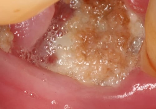 What are the Most Common Complications After Tooth Extraction? A Comprehensive Guide